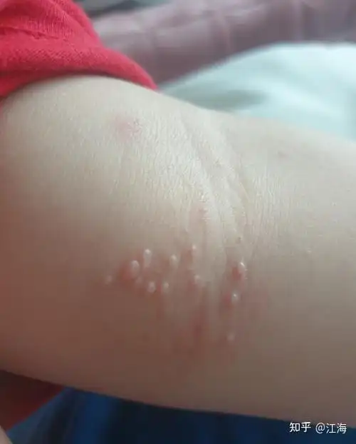 第一次经历水疣,还记得当时带着孩子去医院挂的专家门诊,专家说是传染