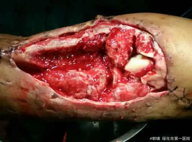 膝关节开放伤骨缺损髌腱缺失一例