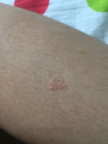 腿上不知道怎么回事自然破皮