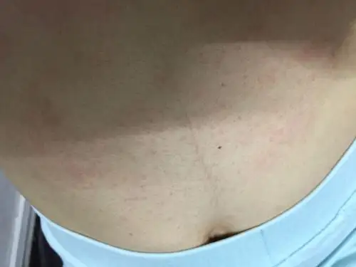 [试管婴儿]孕10周,肚皮上突然好痒好痒,医生不肯开药.