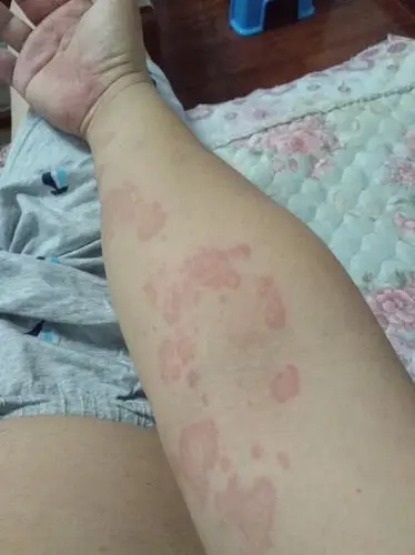 开始得的荨麻疹,快好了又复发了,但是和之前的不太一样,一到晚上就