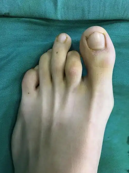 先天性爪趾畸形之一 柔软性(可复性)畸形_先天性足畸形_介绍_治疗方式