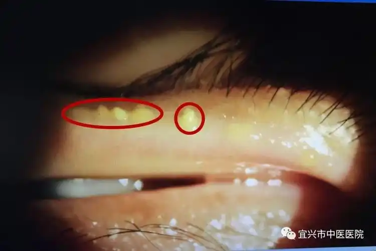 李萍轻轻翻起王女士的眼皮,挤压睑板腺后,许多黄色牙膏状浓稠的油脂就