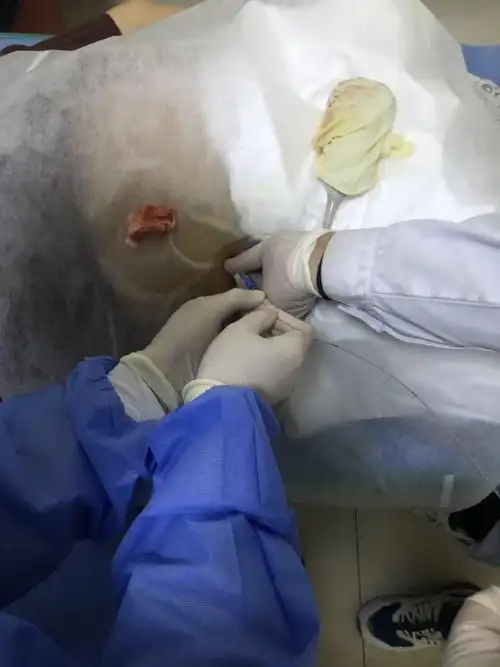 雄安新区容城县人民医院外一科成功为一肾脓肿患者行经皮肾穿刺引流术