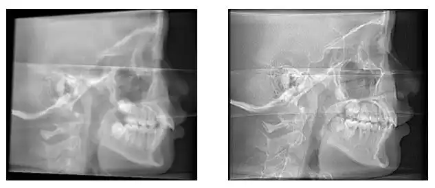 病例分享lorthguide03奥世美03数字正畸导航系统