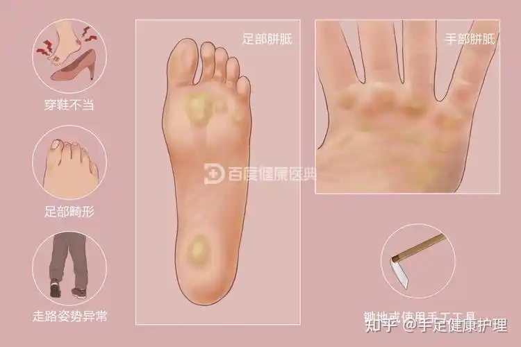 脚垫胼胝鸡眼跖疣刺猴傻傻分不清