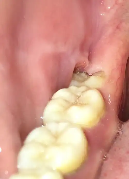 智齿把旁边的肉磨了个坑? 我该去拔牙吗?