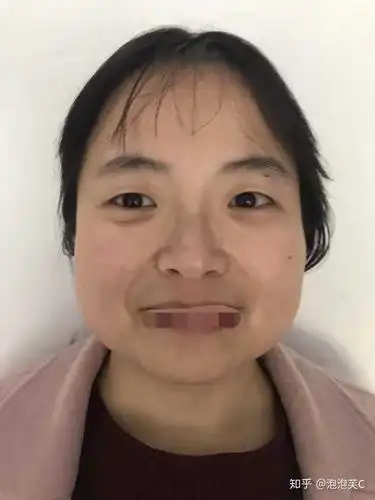 我是正宗梯形脸,头发都遮不住.左右大小还不一样.眼睛 很小.