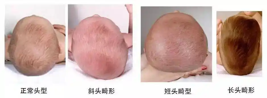 人们通常所说的「扁头」,「偏头」等颅骨畸形,在医学上都被归为扁头