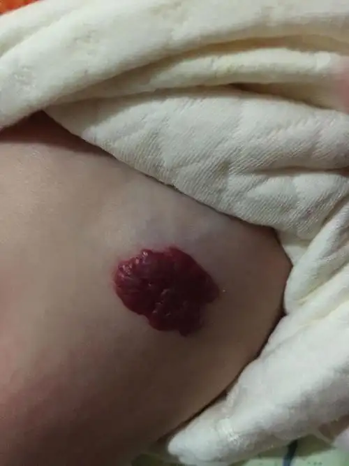 这个是鲜红斑痣吗?这个有什么危害?我宝宝快3个月了,需要治疗吗?