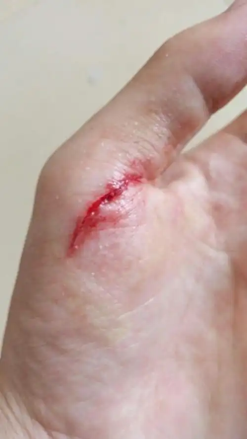 昨天晚上开鱼罐头割伤的,当时用灭菌结晶磺胺和棉花