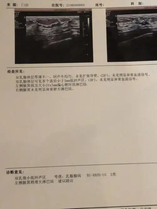 乳腺增生 淋巴结?