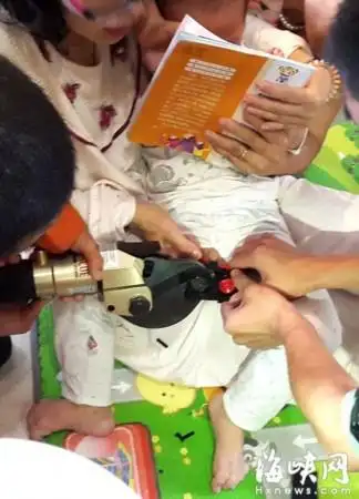 动态  因"蛋蛋"皮周边神经敏感,皮肤很嫩,如何快速处置又不弄疼孩子