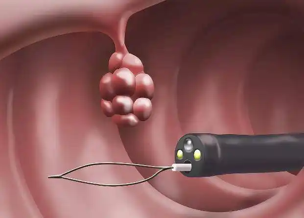 并非便秘那样简单,真相原来是这样_粪便_肠道_肿瘤性