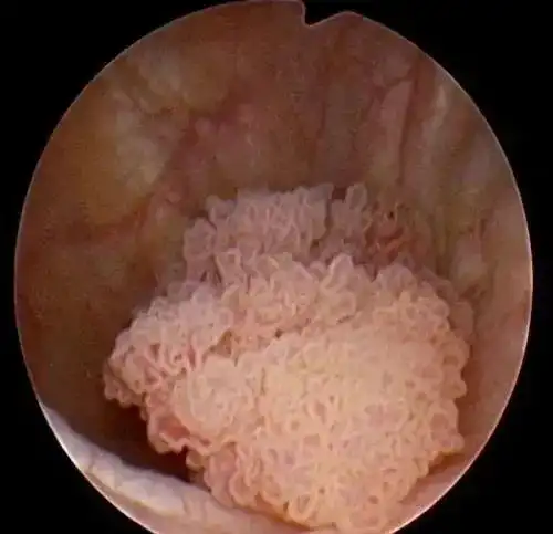 省中医名医教路血尿不重视小心癌症找上门
