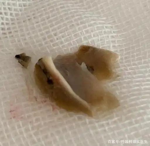 呛咳后一定注意,如间断有咳嗽,咳痰或间断痰带血丝等症状,一定积极找