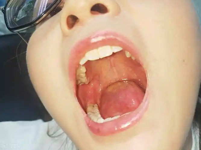 女大学生反复口腔溃疡治不好,实习医生的一句话直接让她破防_宋医生