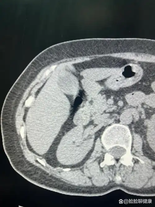 胆囊底部局限性增厚:胆囊腺肌症