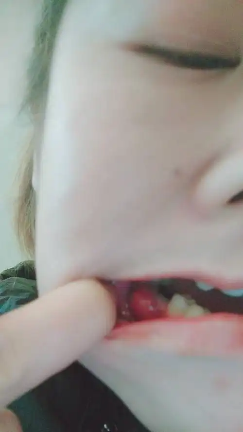 我有更好的答案 2条回答  这种牙龈脓肿需要去牙科切开放脓,当时疼痛