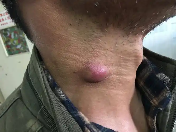 科普从小病开始皮脂腺囊肿