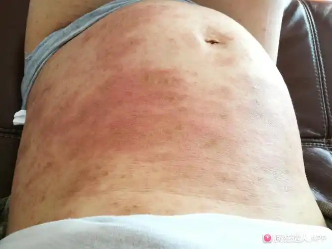 那些孕期痒疹湿疹的亲们,你们还好吗?