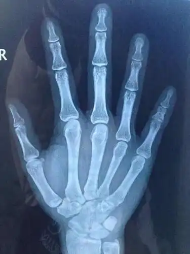 3.x光 屏幕上意外看到自己手掌骨骼惊呆物理学家