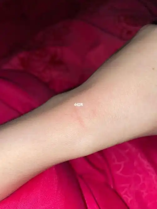 被猫咬到要不要打狂犬疫苗