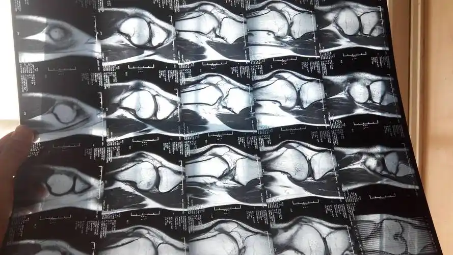 我去医院拍啦磁共振都显示没事.我走路也没事,就是不太敢