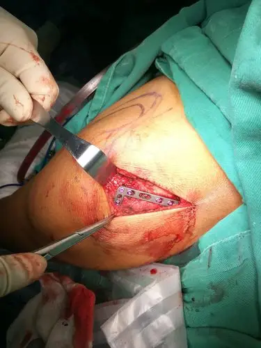 手术治疗肩关节悬吊复合体四联损伤 - 好大夫在线