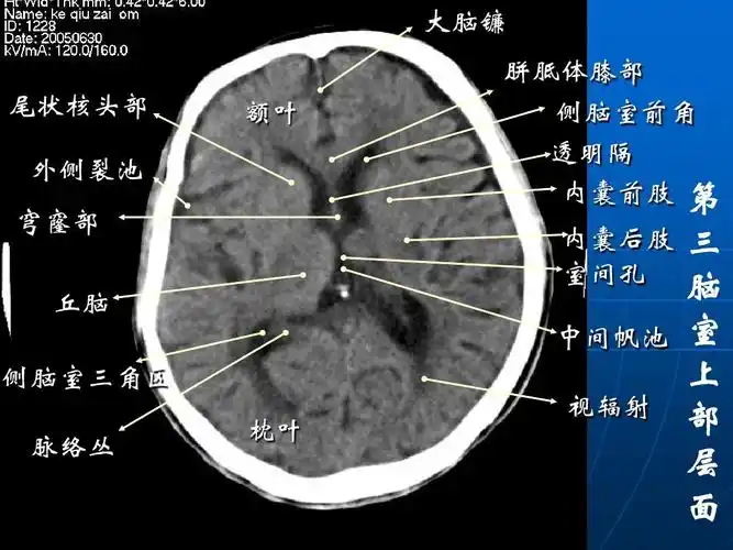 头颅ct解剖及诊断ppt