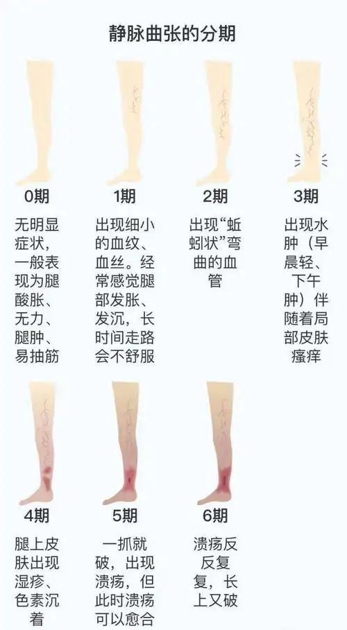 关于静脉曲张的那些事儿|瓣膜|下肢静脉曲张|手术_网易订阅