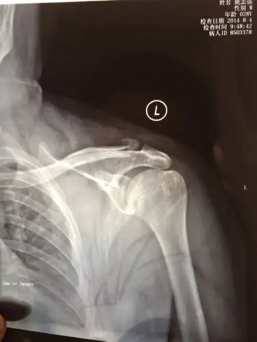 我骑车不慎将左侧肩膀摔伤,去医院拍片诊断为左侧锁骨肩峰端骨折,10
