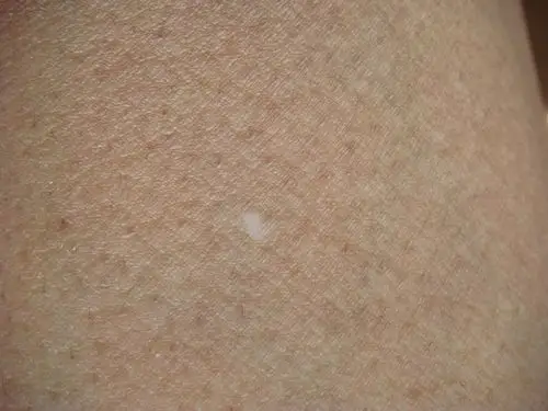 请懂行的看看这小白斑是啥?