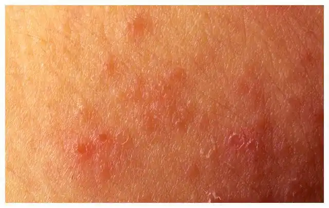 外阴瘙痒硬化性苔藓外阴干枯越拖越严重外阴白斑3大类型