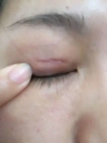 双眼皮去皮手术一个月了,伤口这样正常吗?