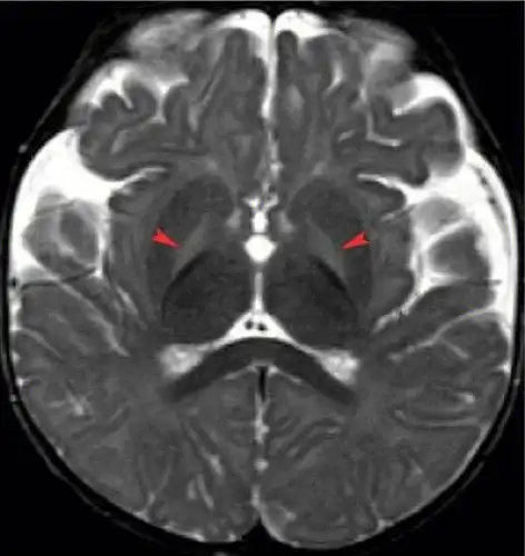 头颅mri胆红素脑病的特征性异常信号