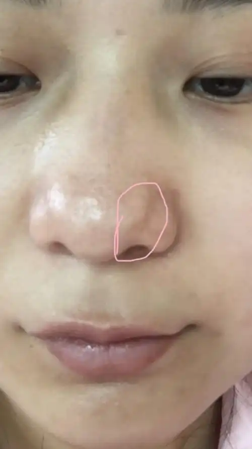 医生解答:您说的是一种非常典型的情况,在鼻子上由于皮脂腺的增生