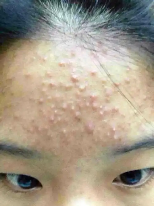 什么是闭口粉刺性痘痘?