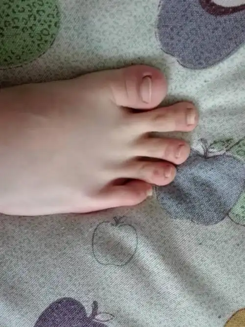 请问这种脚是畸形吗?为什么大脚趾会这么短