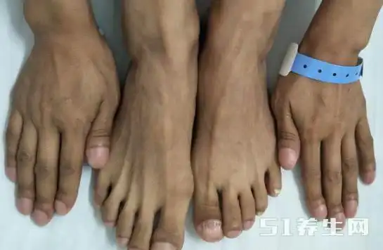 男子手指脚趾变形不重视10个月后肺部竟然长鳞癌