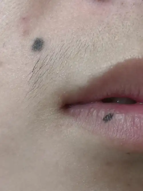 解决皮肤问题专注皮肤美容##色素痣##美容