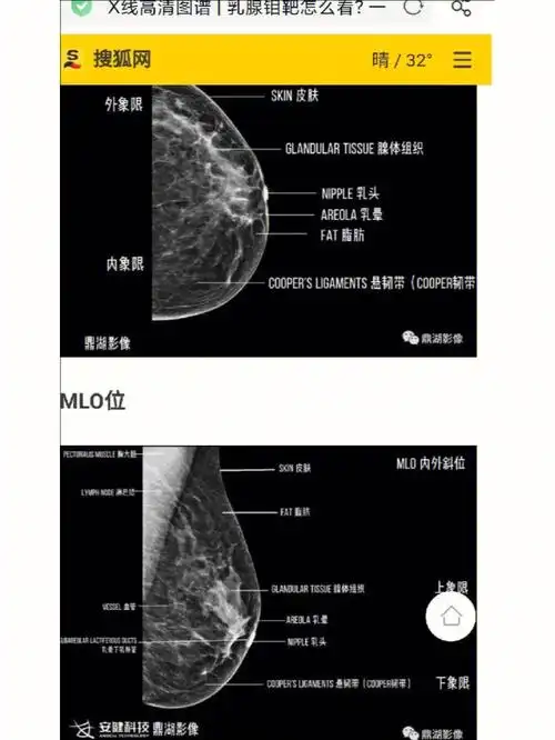 乳腺科今天有16个病人,几乎是昨天的一倍,有一个乳房肿痛的病人肿块很