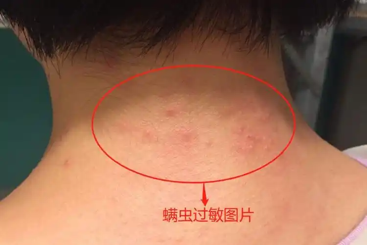 身上螨虫过敏症状图片