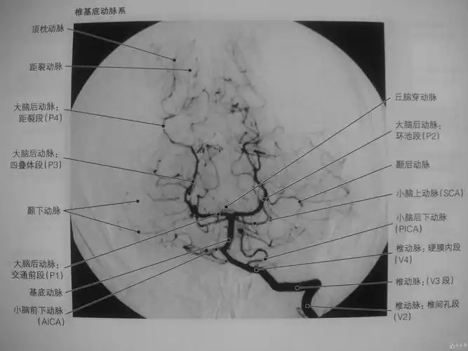 颅内动脉分析