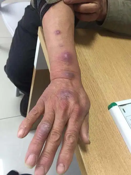 皮肤超声▎洗鱼引发的皮下结节