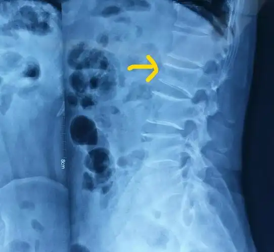 术前x线平片示腰2椎体明显压缩骨折,压缩约1/2.