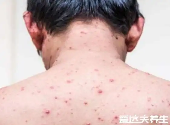 不同时期的艾滋病皮疹图片及症状,不痛不痒的小红点更需注意