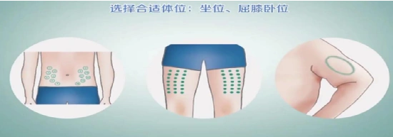 肚脐周围(脐周2cm内禁止注射),上臂三角肌下缘,大腿中段正面和外侧