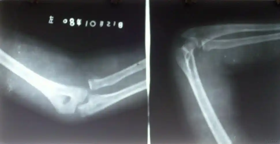 右肱骨内髁骨折并桡骨小头脱位