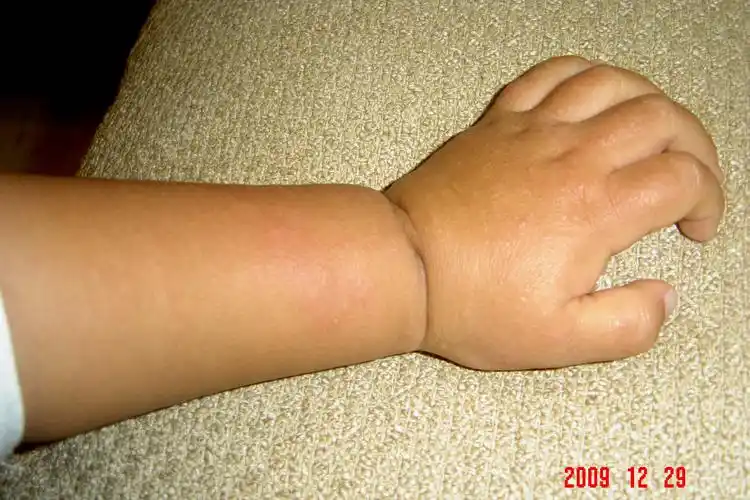 呼叫xushi2岁半男孩手上皮肤病帮助诊断一下多谢焦急的父母